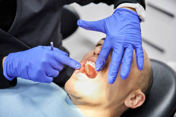 Best Knocked-Out Tooth (Avulsed Tooth) Treatment in Port Angeles, WA